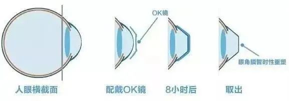 进口医疗器械角膜塑形镜若何报关？